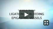 Ligation of Bleeding Epigastric Vessels