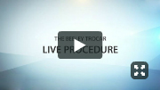 The Beeley Trocar - Live Procedure
